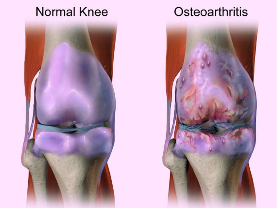 osteoarthritis,退化性關節炎
