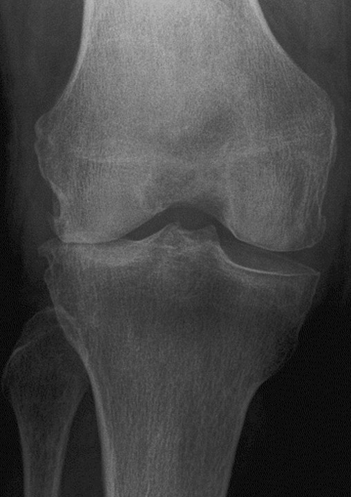 osteoarthritis,退化性關節炎