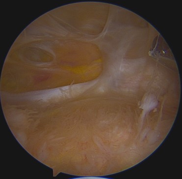 osteoarthritis,退化性關節炎