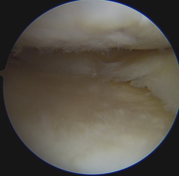 退化性關節炎,osteoarthritis