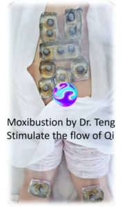 Intensive Moxibustion by Dr Teng with Ginger