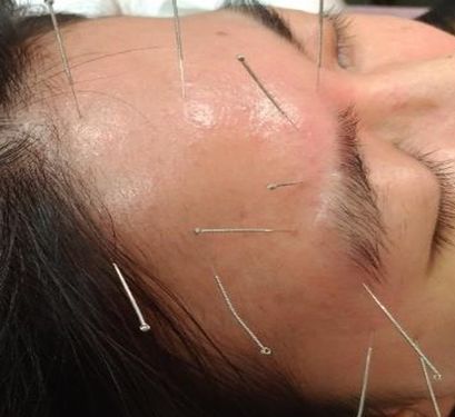 acupucture